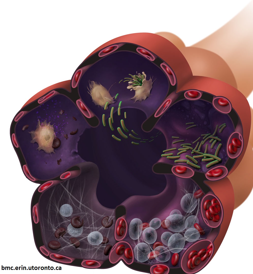 picture of the alveoli infected with bacterium